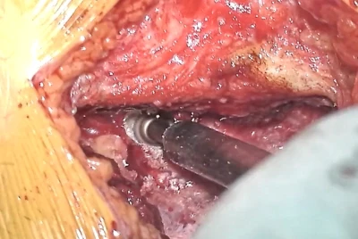 Lumbar microdiscectomy