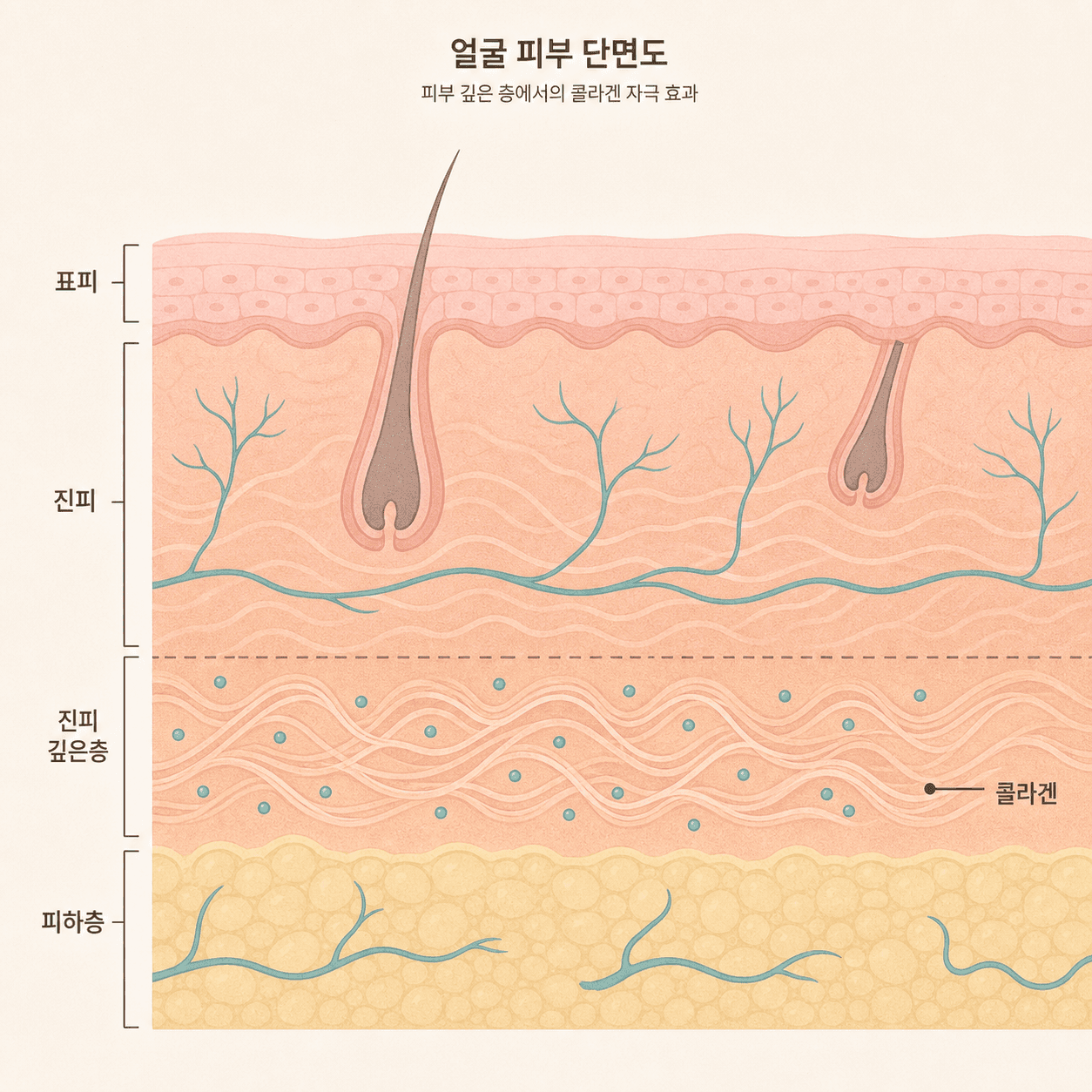 피하층에서 콜라겐 생성을 유도하는 모습