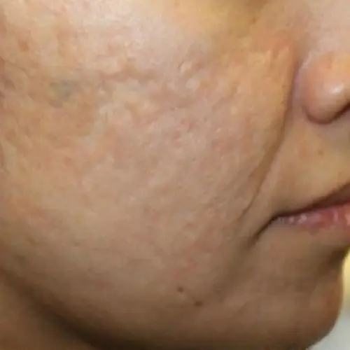 After laser treatment for cystic hormonal acne at The Vancouver Aesthetician — skin cleared and inflammation resolved