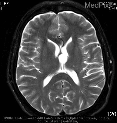 MRI image of a brain