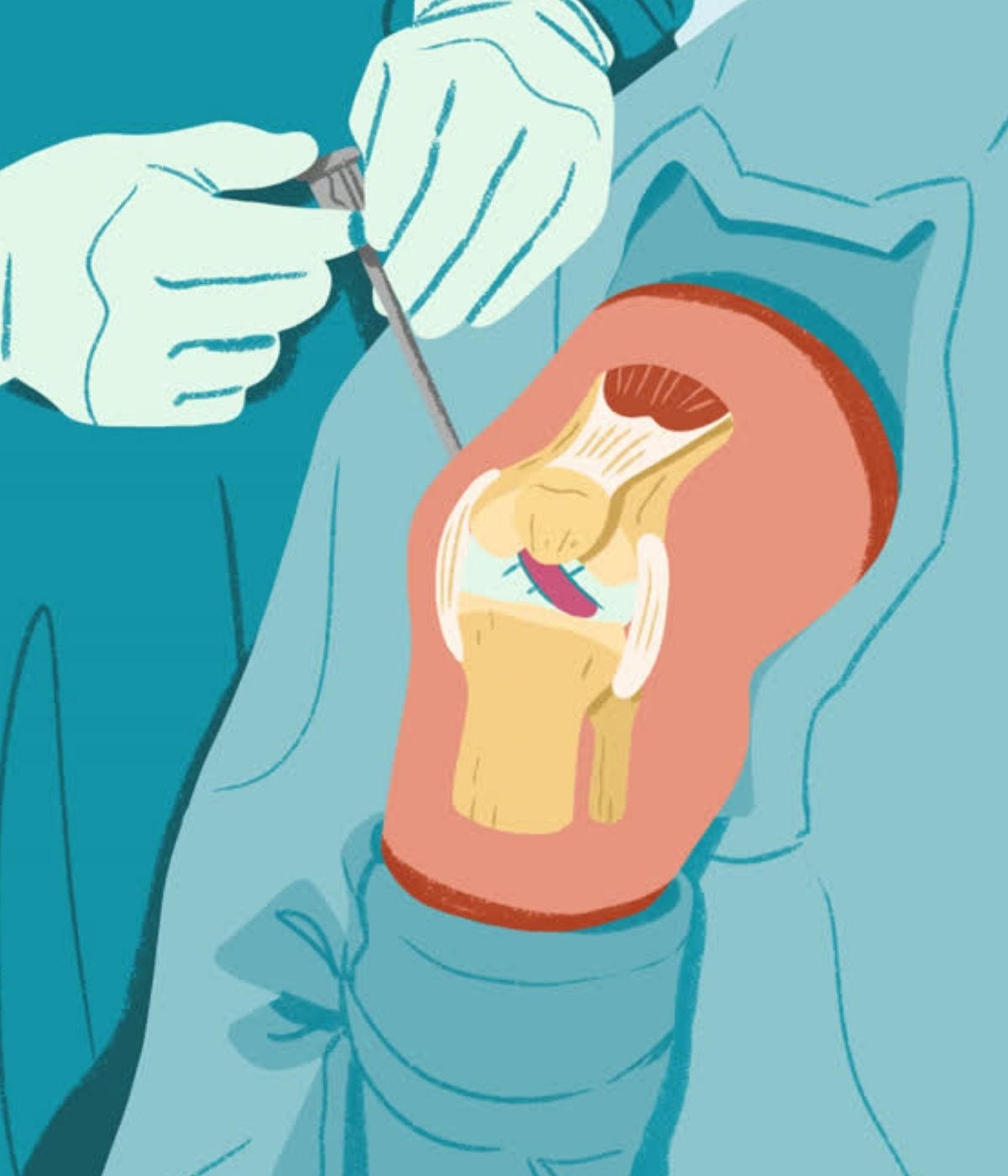 COBLATION Treatment of knee