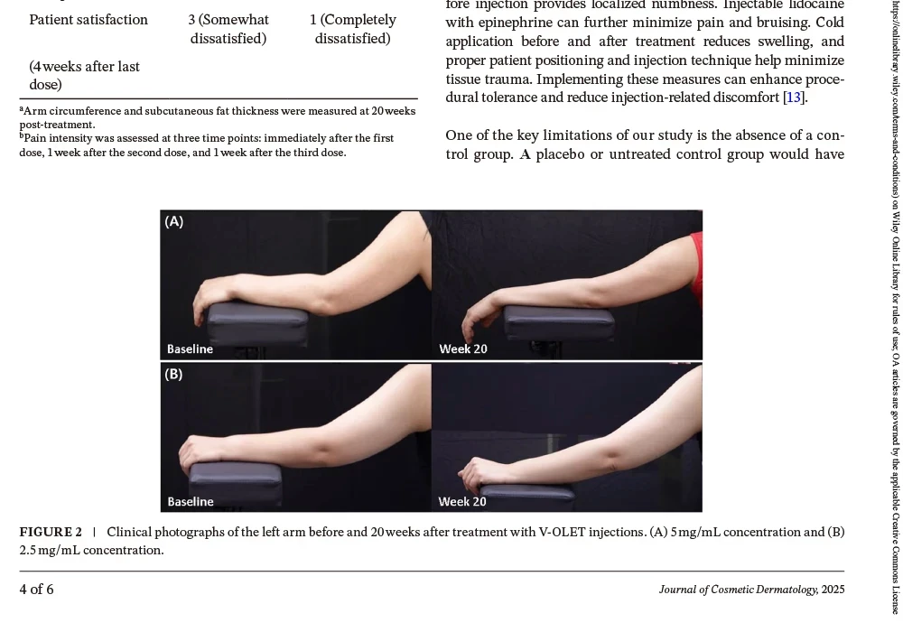 V-OLET injections provide significant arm fat reduction.