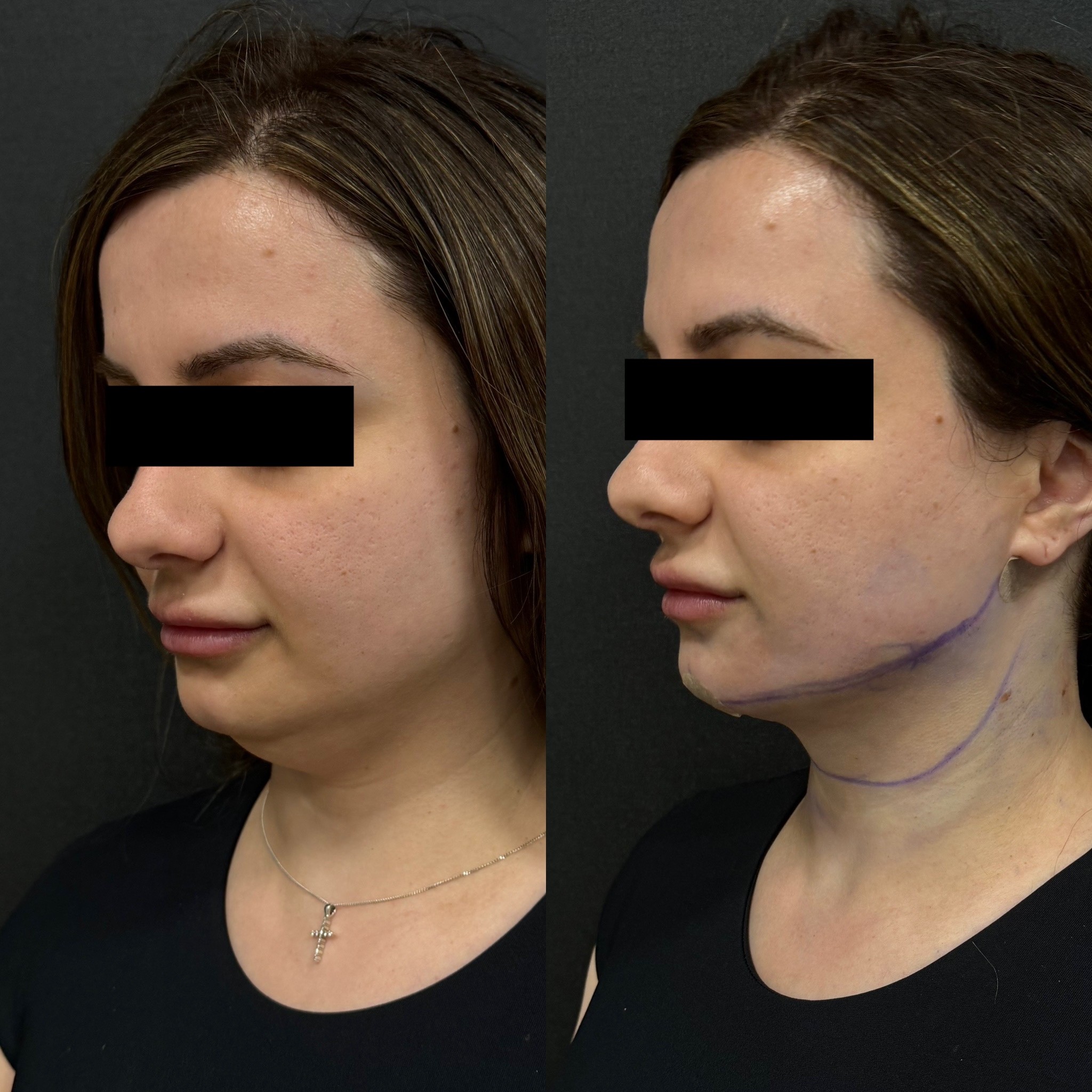 neck laser liposuction immediate post-surgery before after oblique view