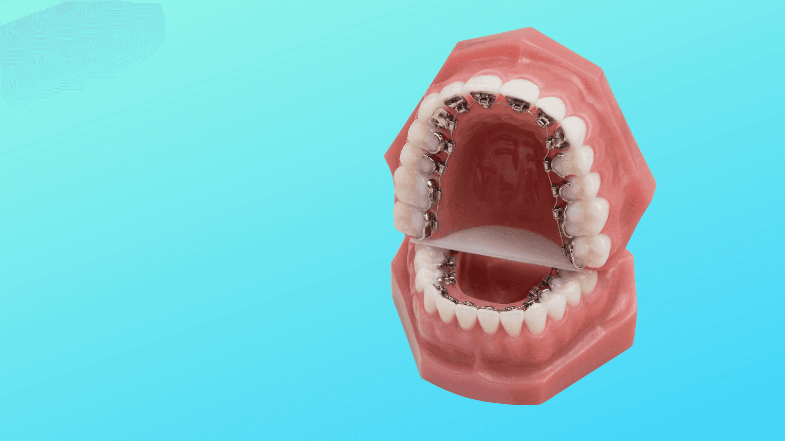 Self-Ligating Lingual Braces at Midtown Orthodontics in Midtown Toronto, Ontario