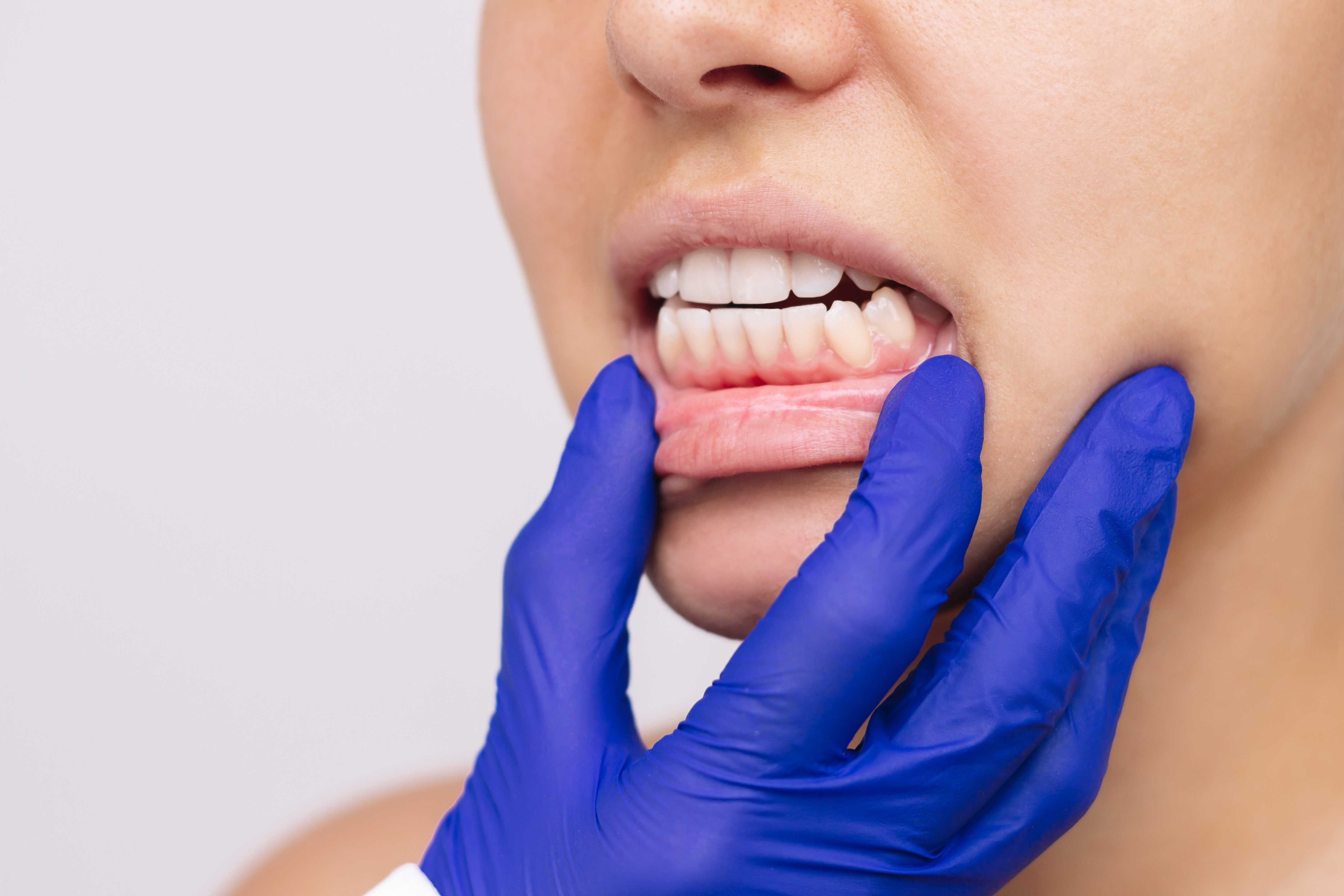Close-up da boca de um paciente evidenciando mordida aberta anterior, sem contacto entre dentes superiores e inferiores