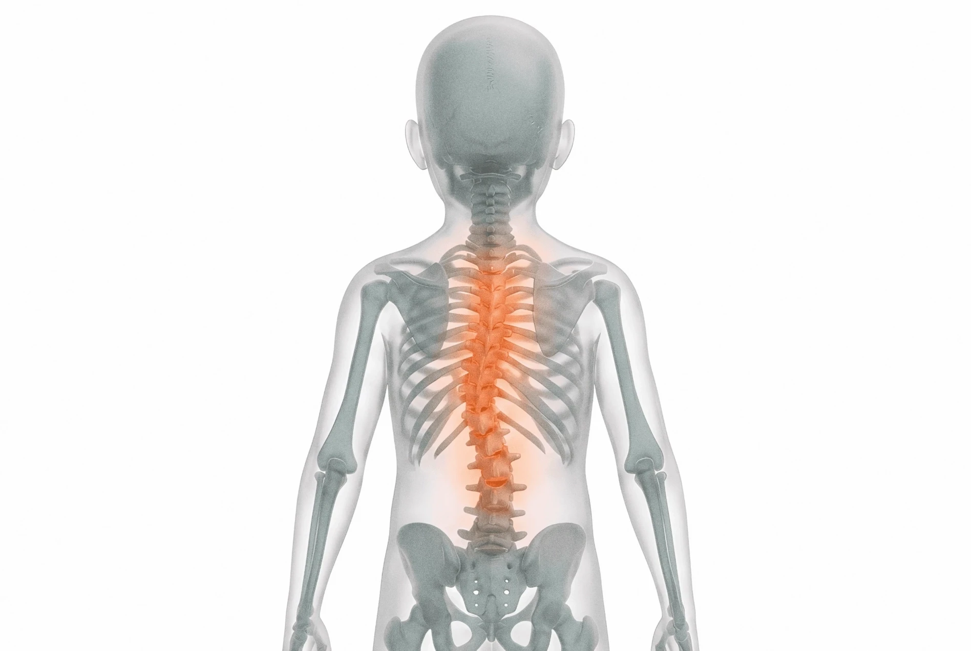 Child Scoliosis