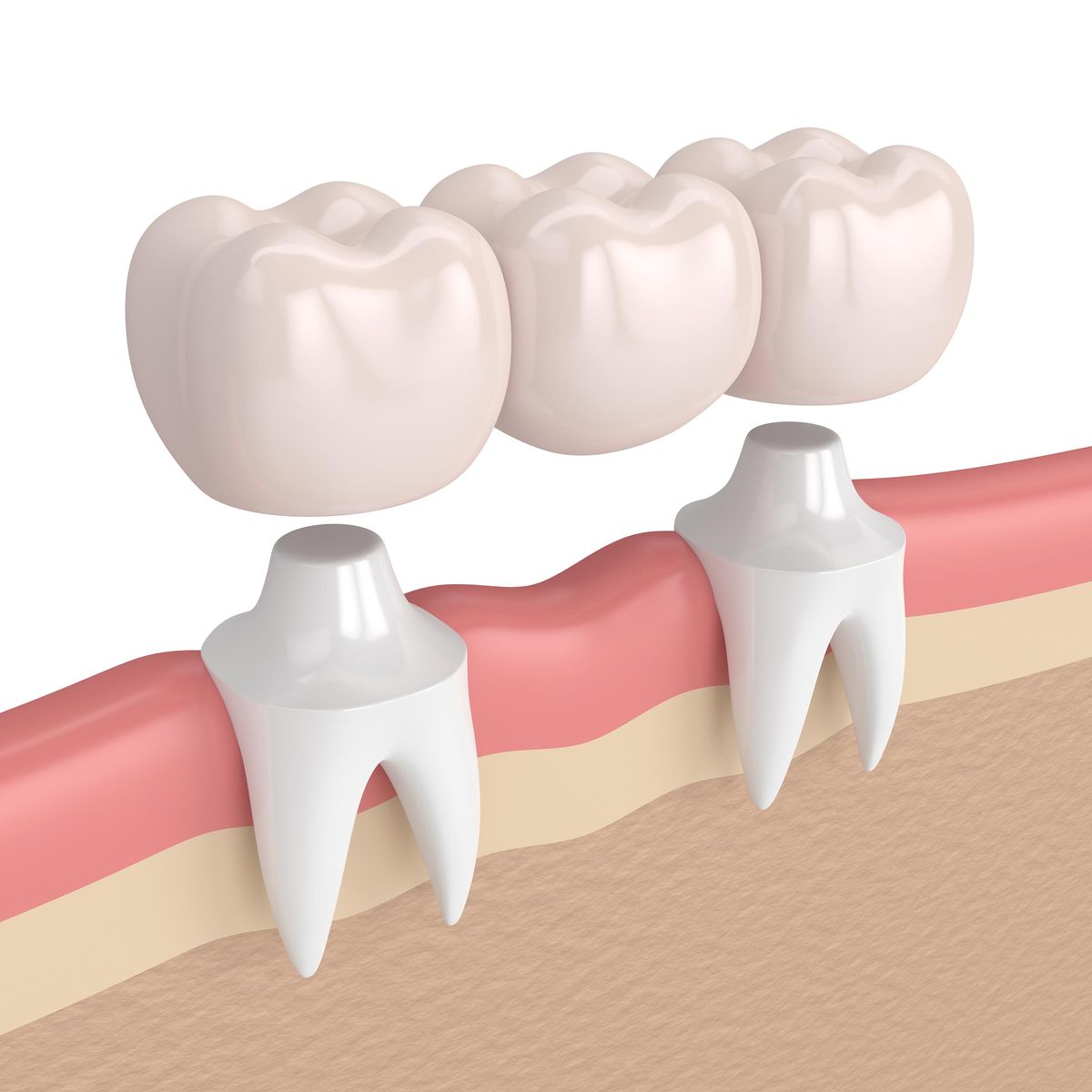Dental Bridges in Hurghada - Sun Clinics