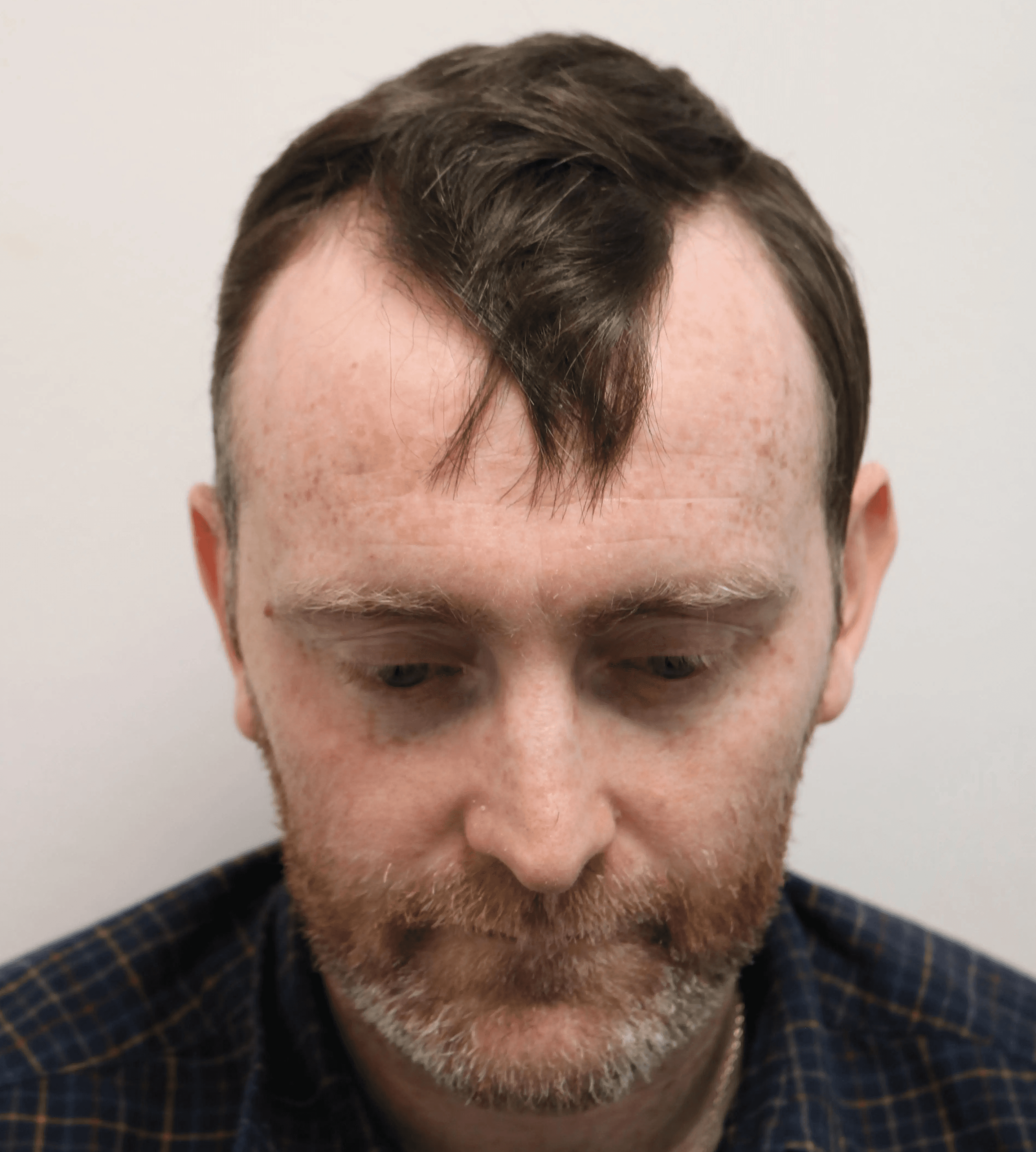 Before hair transplant – Ben's FUE Hair Transplant