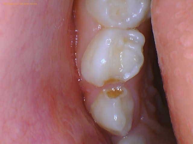 Close-up clinical image of a child’s back teeth before treatment, showing a cavity in a baby tooth next to the molars.