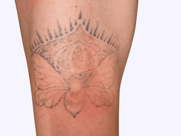 Female, 3 sessions after treatment