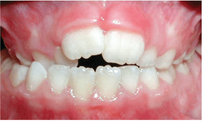 crossbite_back_teeth