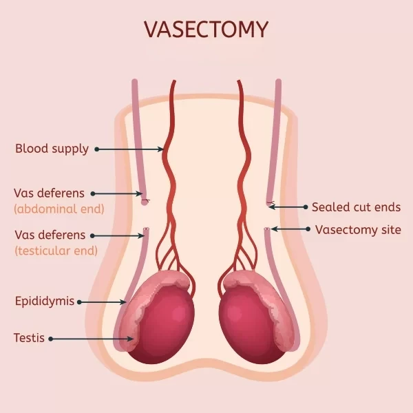 Vasectomy infographic