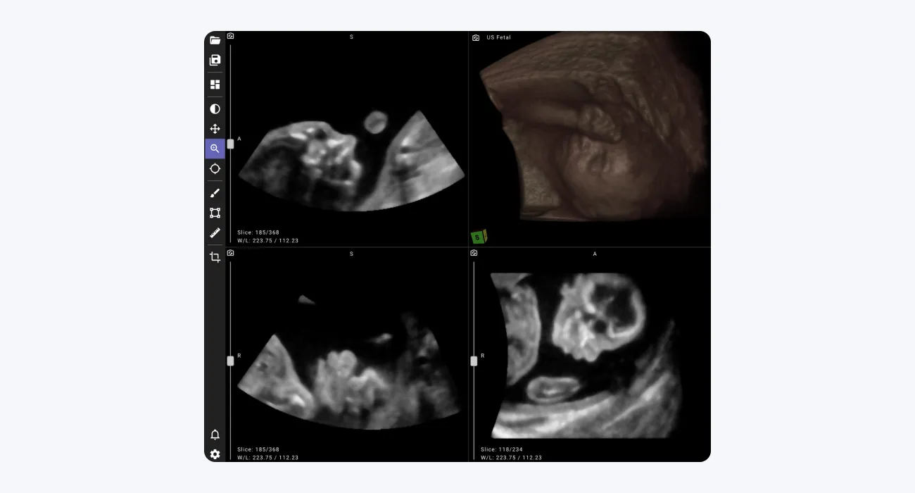 An example of a volumetric ultrasound dcm file displayed in an advanced DICOM viewer with 3d rendering functionalities