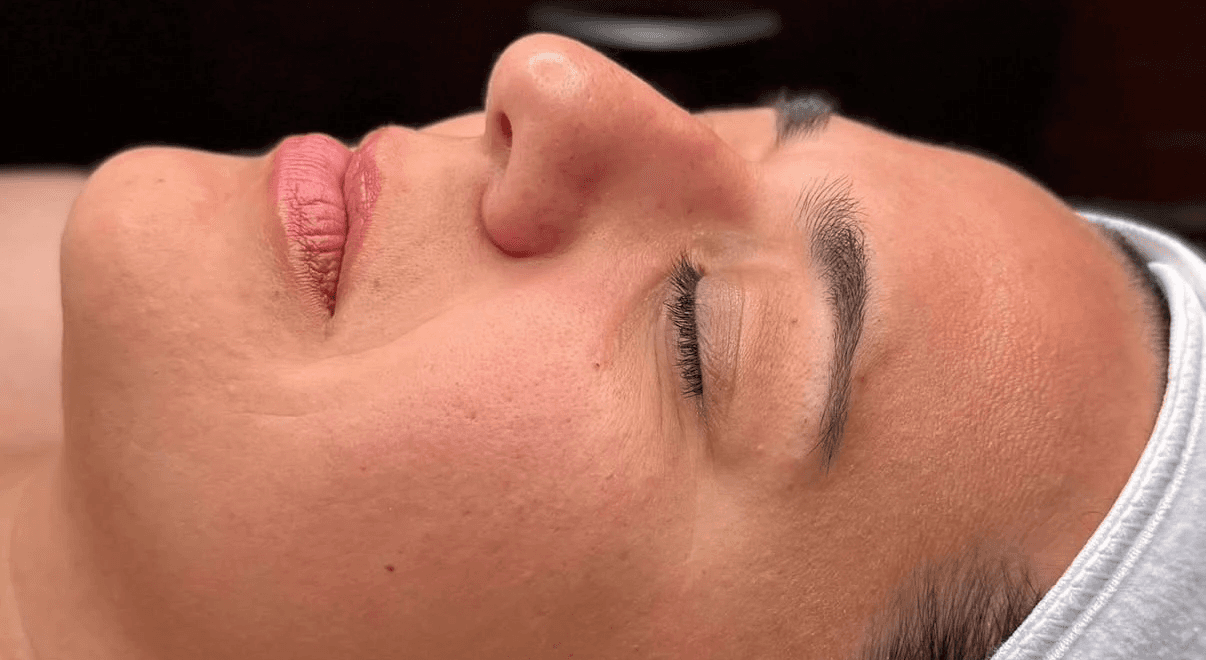 Hydrafacial treatment skin radiance before.