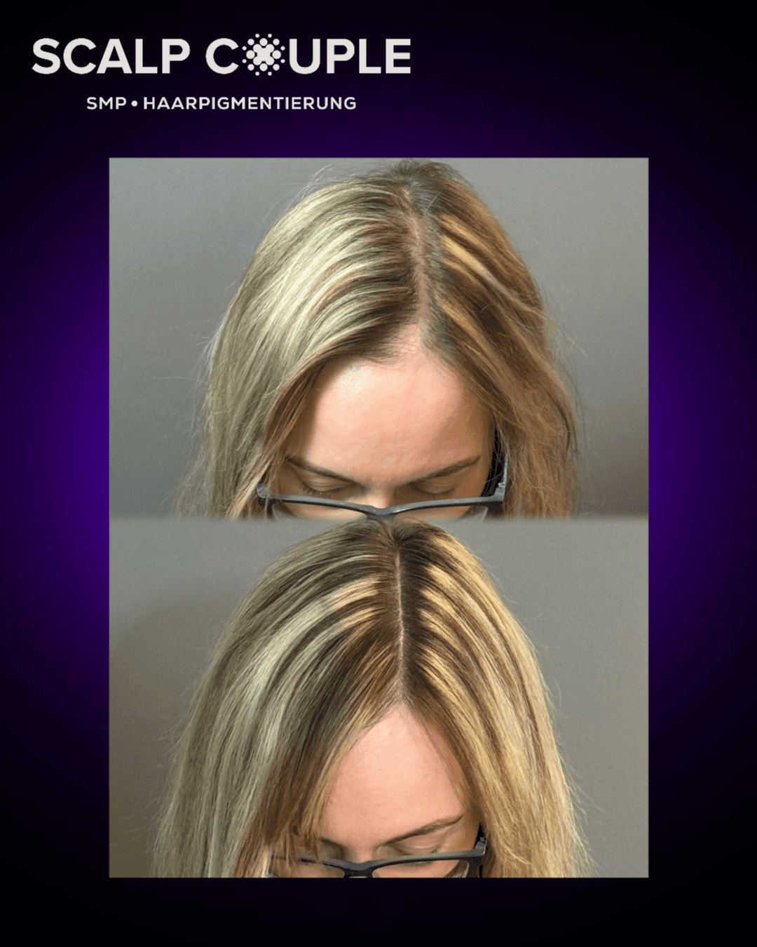 Haarpigmentierung Frau Vorher Nachher – SMP Ergebnis | Scalp Couple