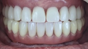 Fogászati Implantátum Tájékoztató