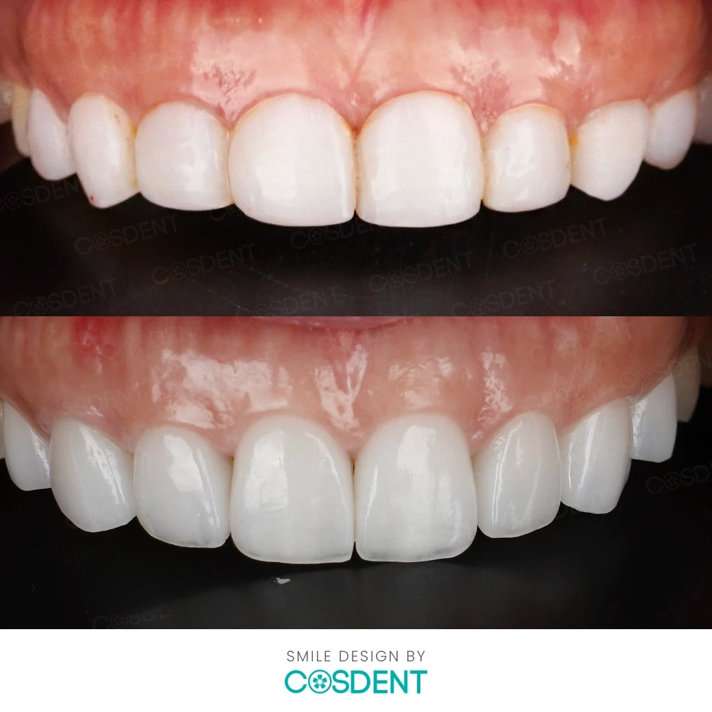 รีวิวออกแบบรอยยิ้ม ที่ cosdent smile design