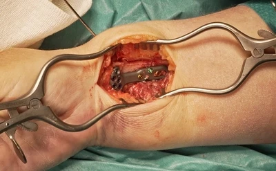 Distal radius fracture