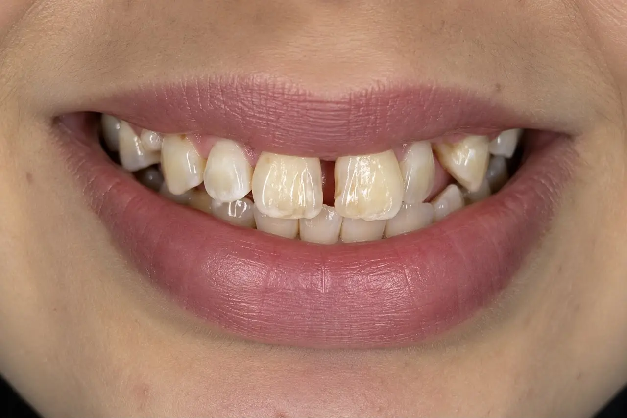 Avant traitement esthétique du sourire montrant les dents naturelles de la patiente.