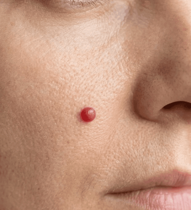 Angiomas removal in winnipeg