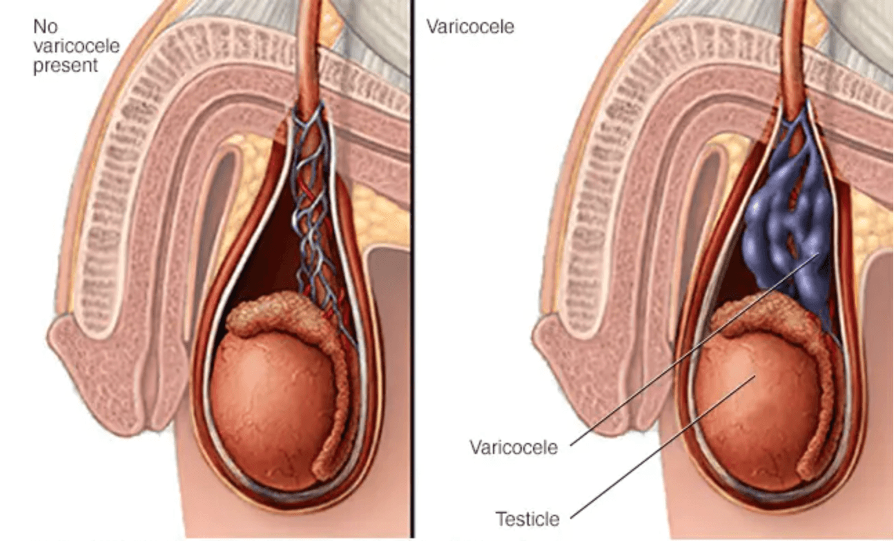 Testicular Varicocele