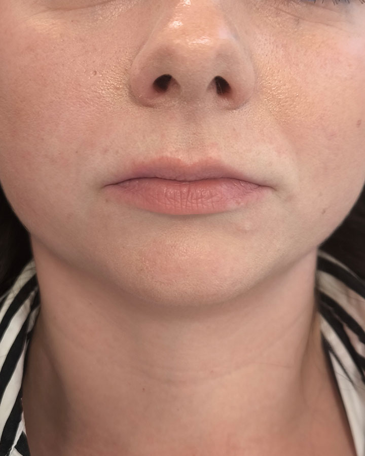 Nevýrazné kontúry pier pred aplikáciou kyseliny hyalurónovej značky Modelha