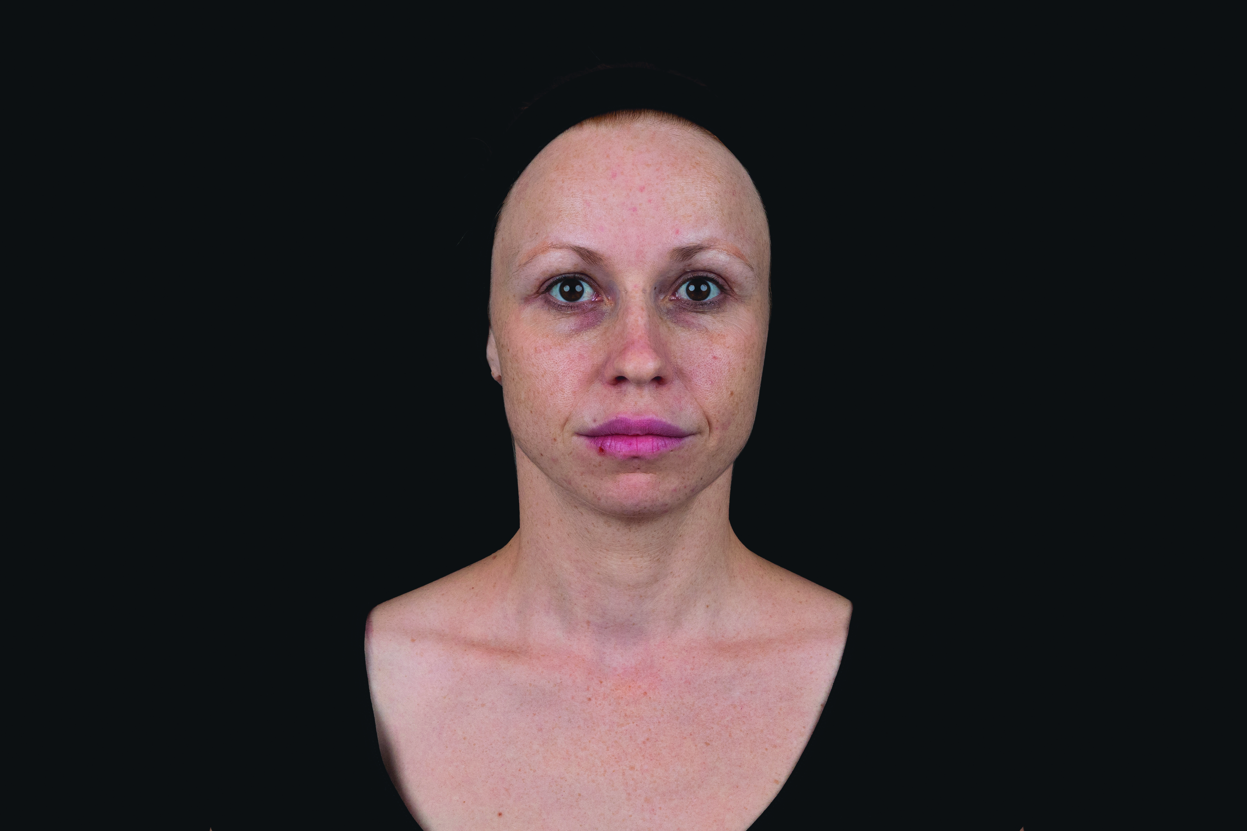 Female patient before Saypha Volume Lidocaine dermal filler treatment front view