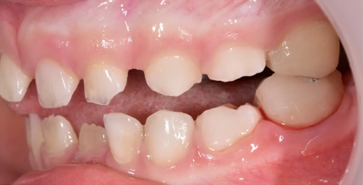 Right after the overlays cementation