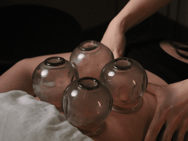 Cupping therapy on a patient's lower back