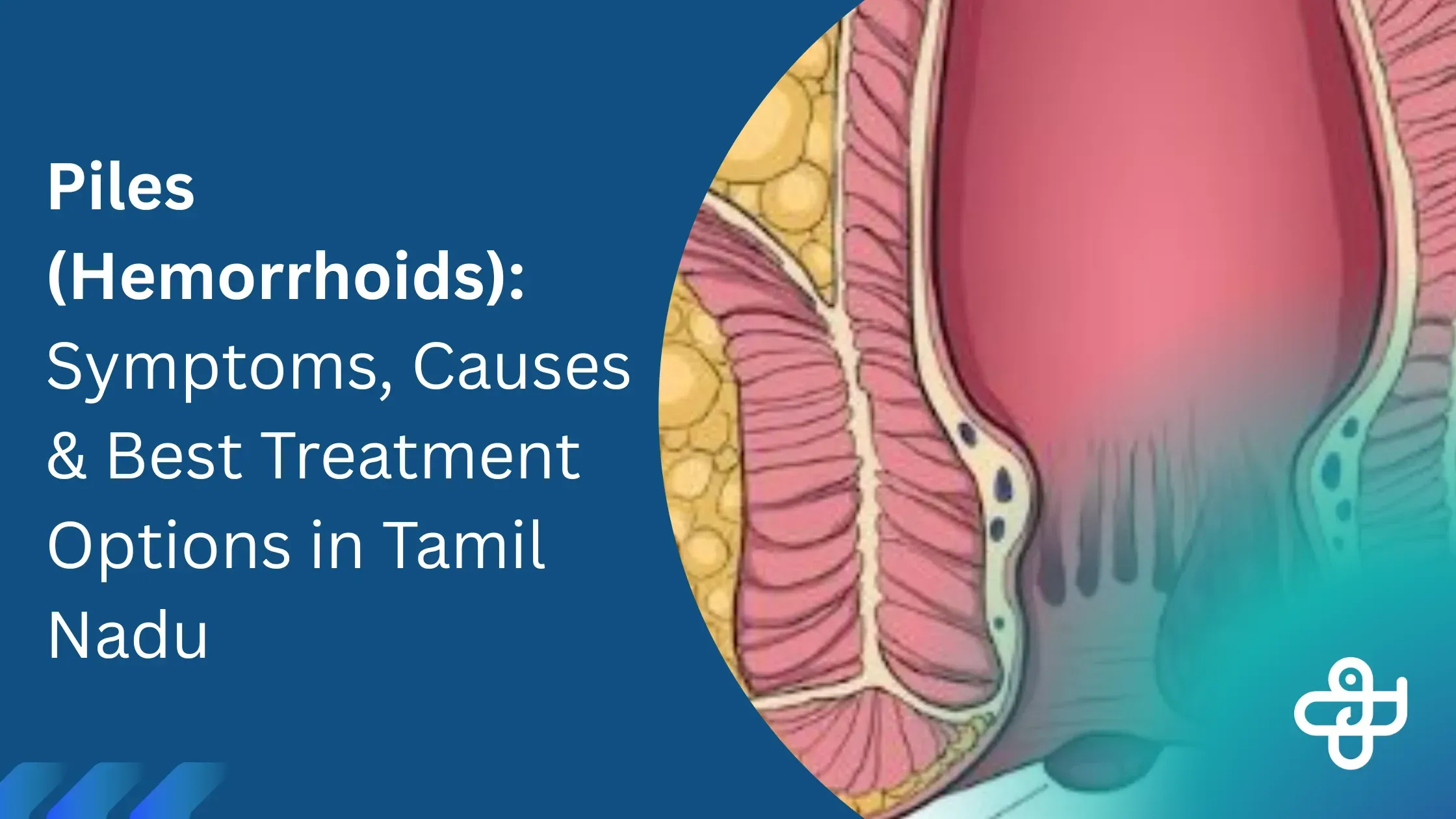 Laser Piles Treatment