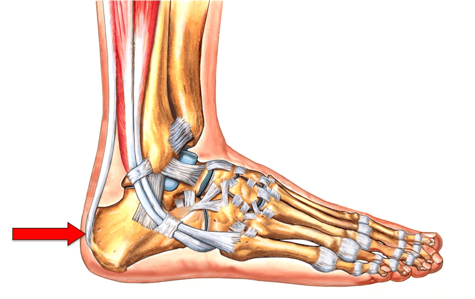 illustration of calcific tendonitis