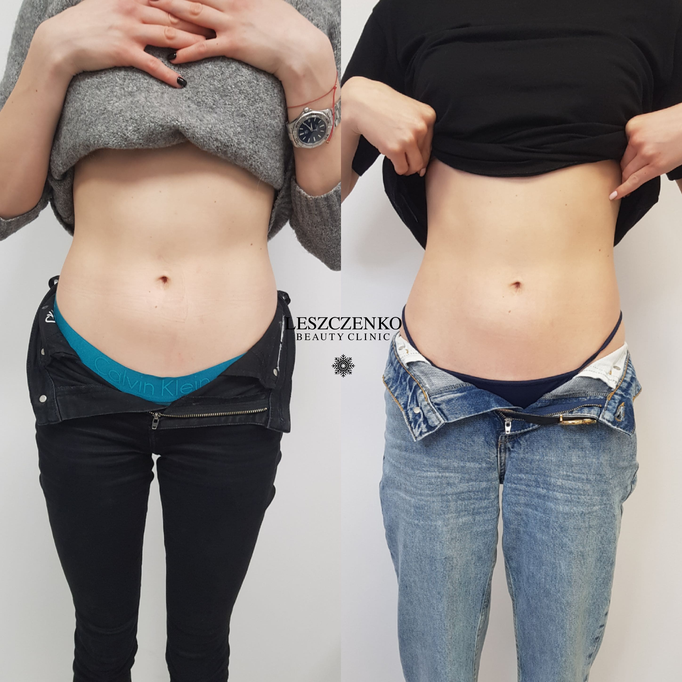 Kriolipoliza kontrastowa szczecin