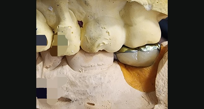 커스텀 자체가공 후 버컬부분 레진 페이싱