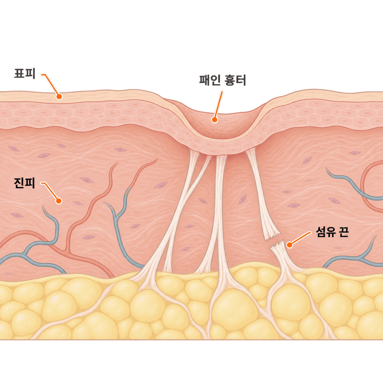 흉터 바닥을 붙잡는 섬유 끈을 끊어 꺼진 자리가 올라올 공간을 만들어요