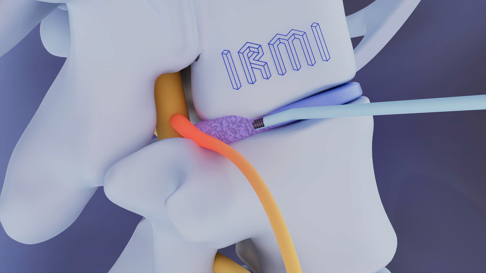 Animation 3D d’une herniectomie percutanée réalisée pour IRMI