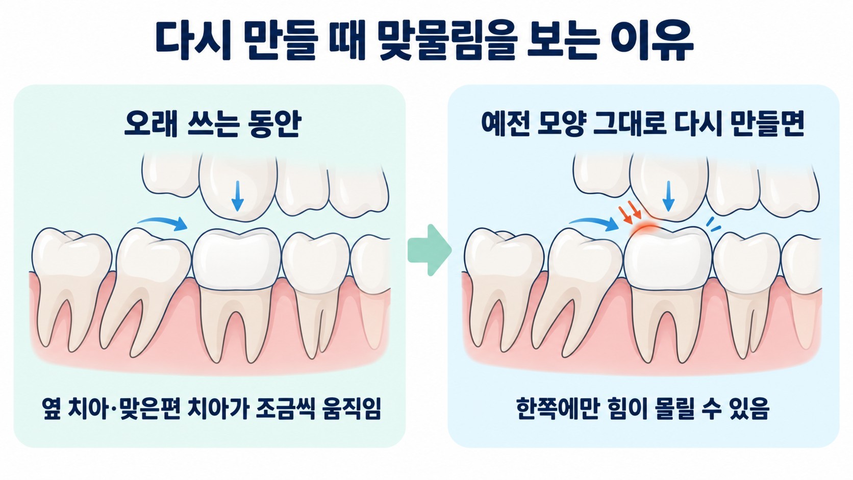 크라운을 오래 쓰는 동안 주변 치아가 움직여 예전 모양대로 다시 만들면 한쪽에만 힘이 몰리는 맞물림 변화 일러스트