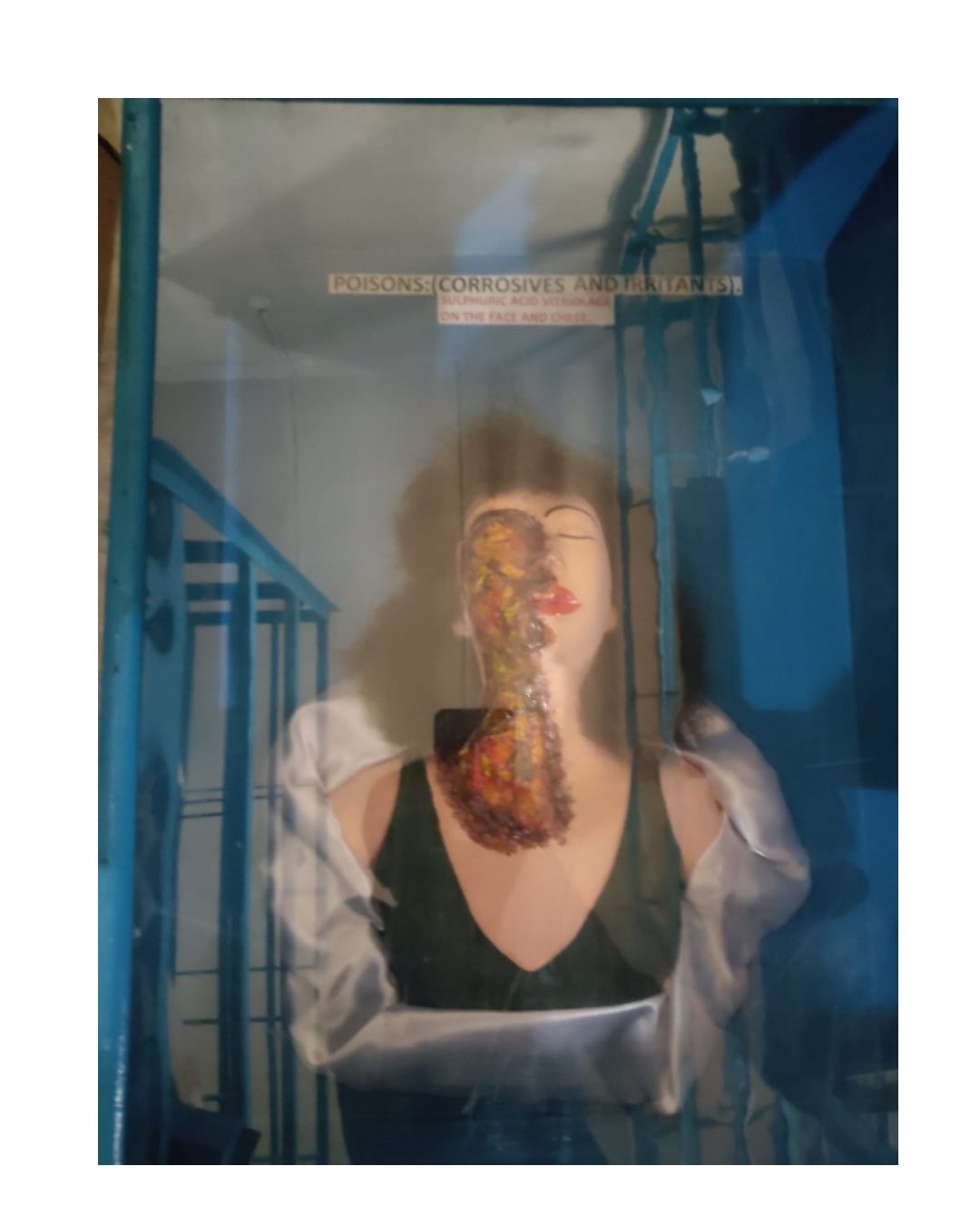 Poisoning – Face & Neck Corrosion Model