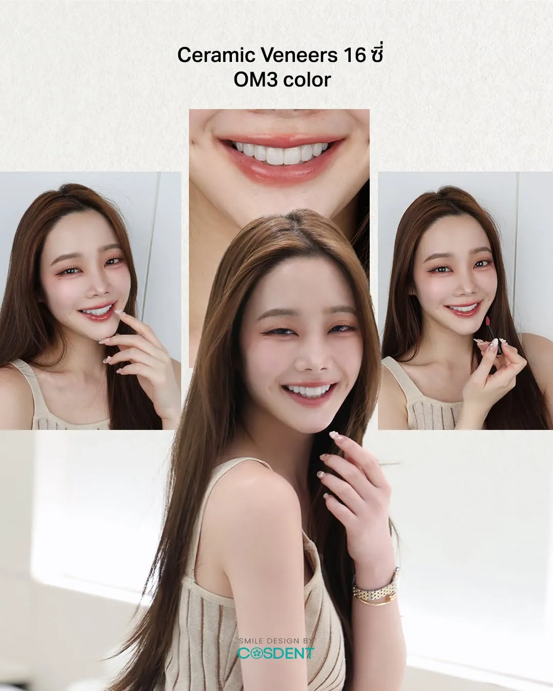 Ceramic veneers on 16 teeth in shade OM3 — smile design case at COSDENT Bangkok
