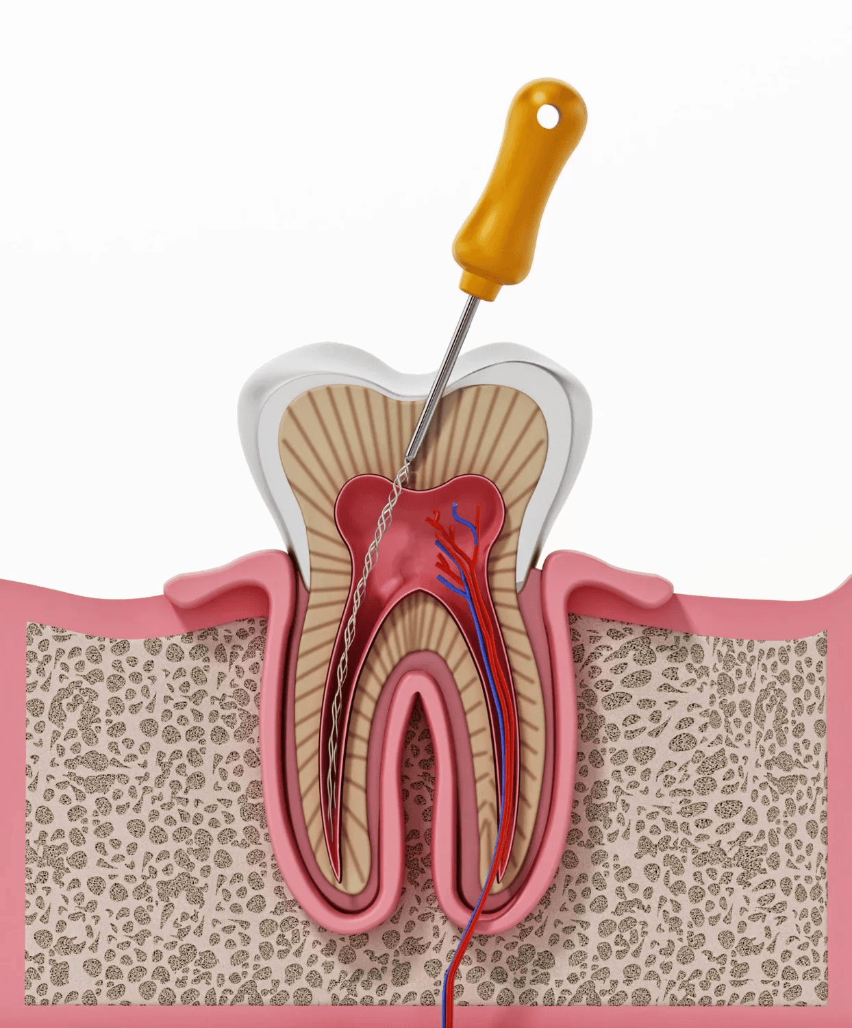 Root canal treatment, endodontics, Goa, Panaji, Panjim