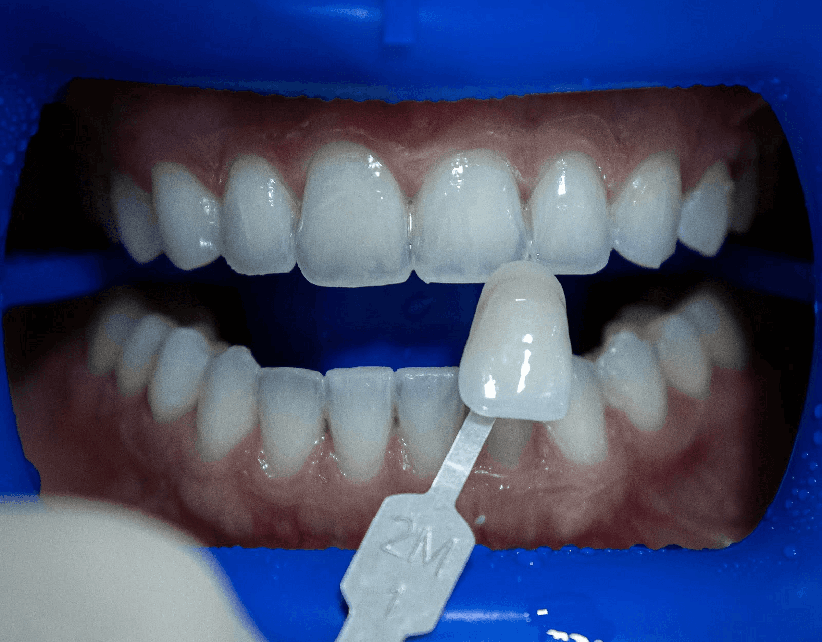 Cosmetic dentist at Bella Medical carefully placing a veneer on a patient's tooth during a Hollywood Smile procedure.