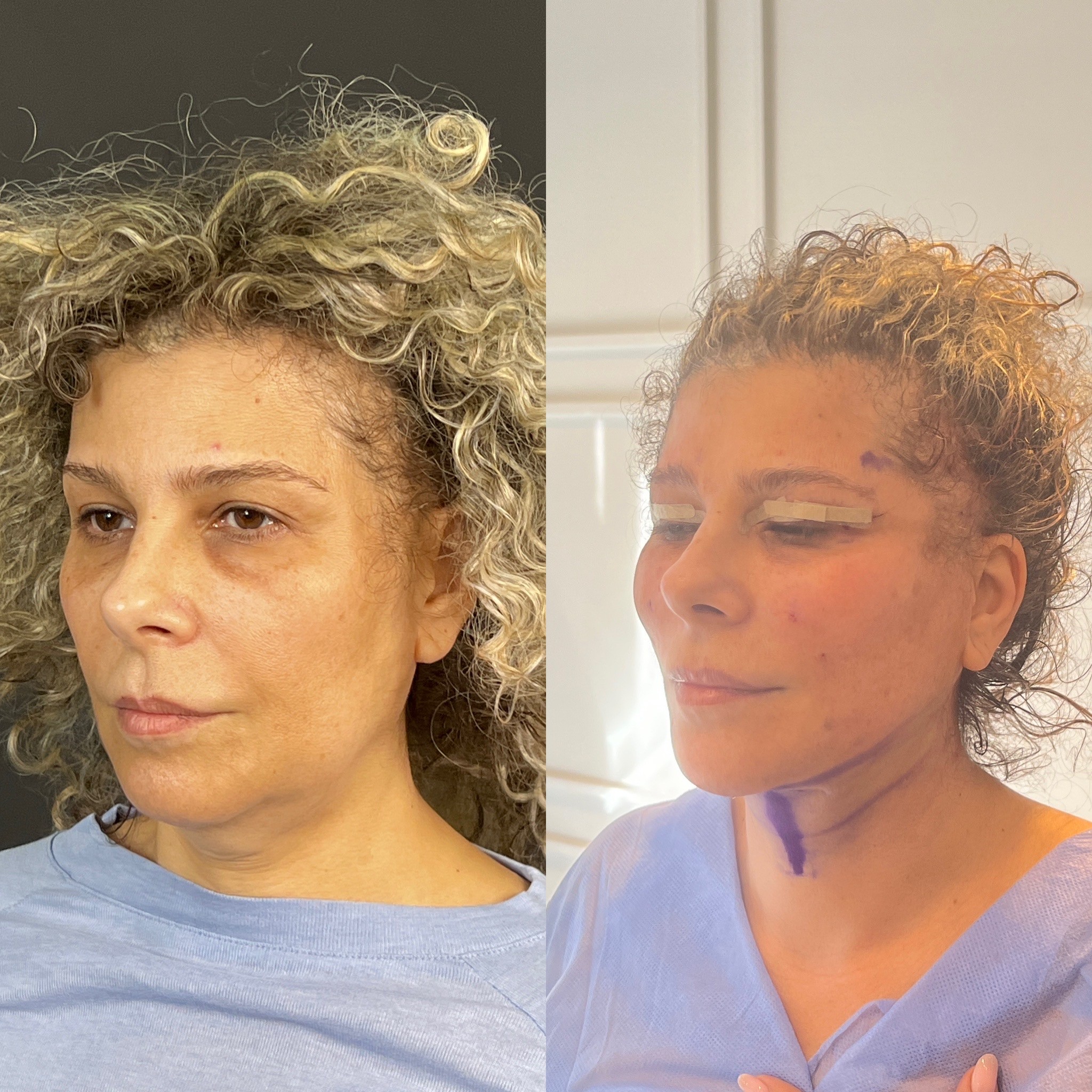 turkey neck chin liposuction thread lift immediate result oblique view