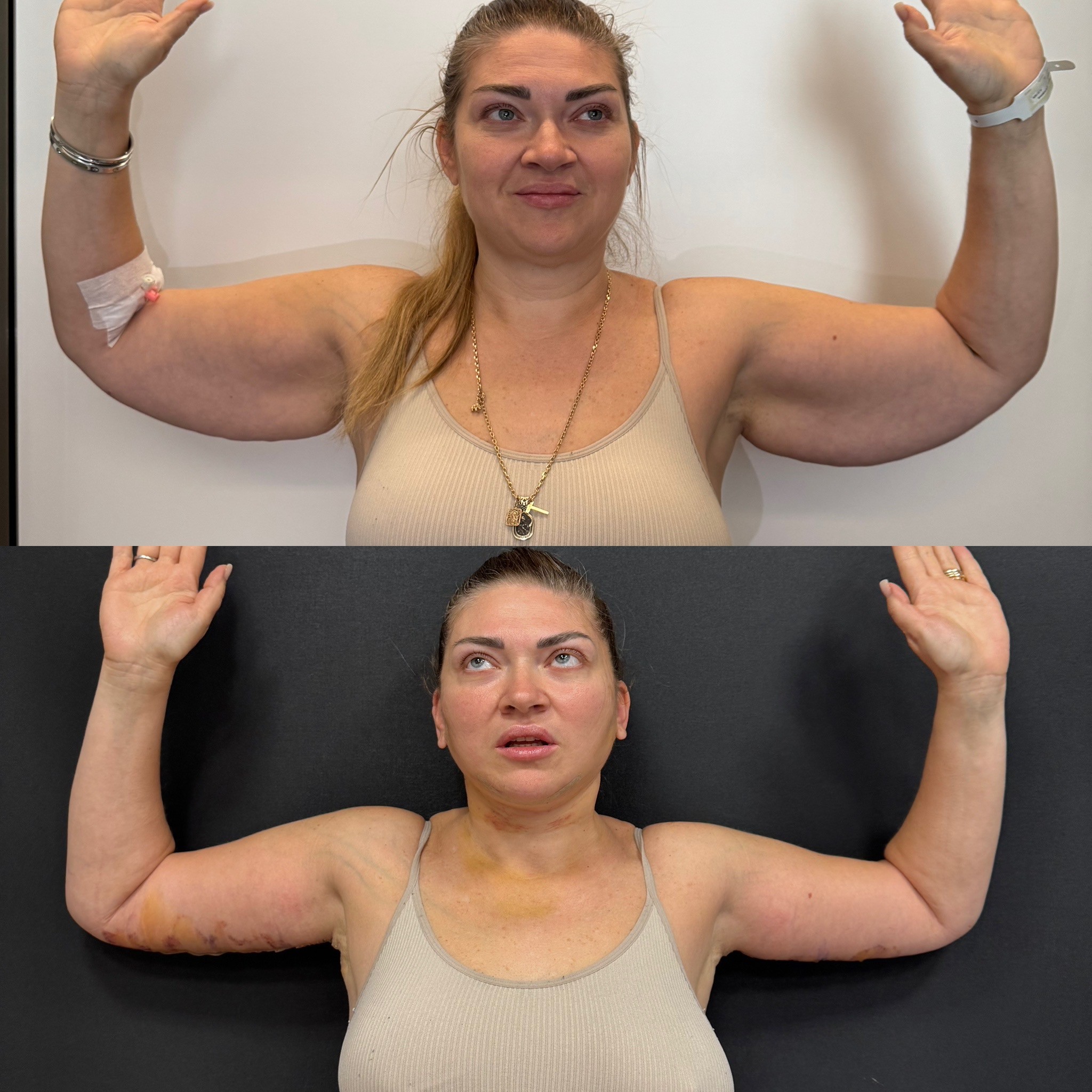 arm lift before after photo of Dr.CBS's patient in Istanbul, Turkey front view