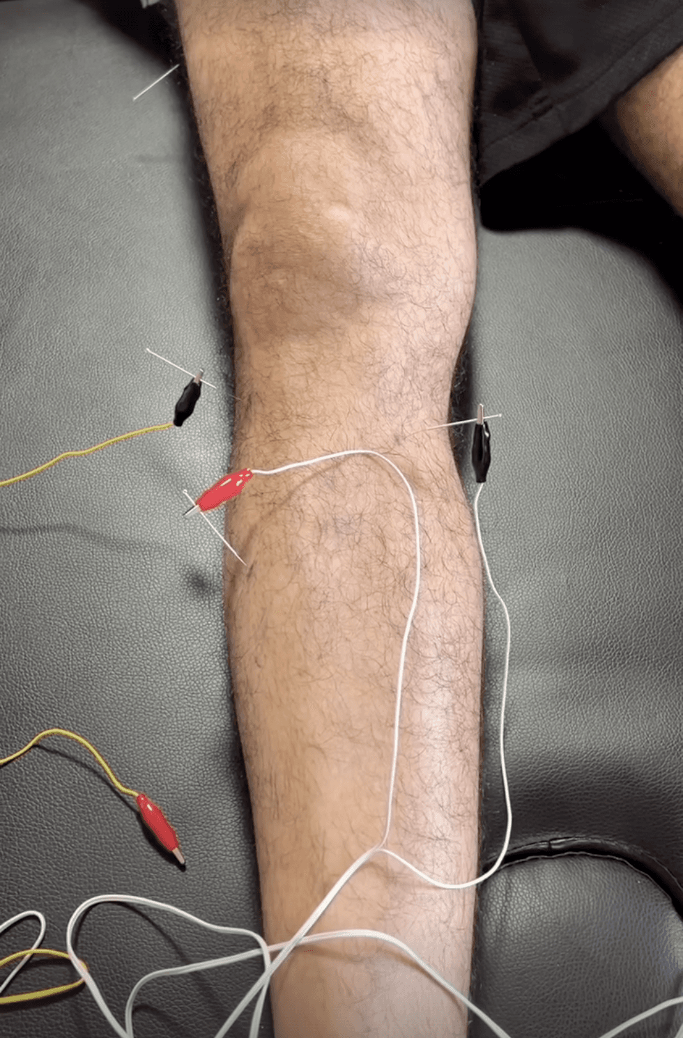 Acupuncture for Knee Pain