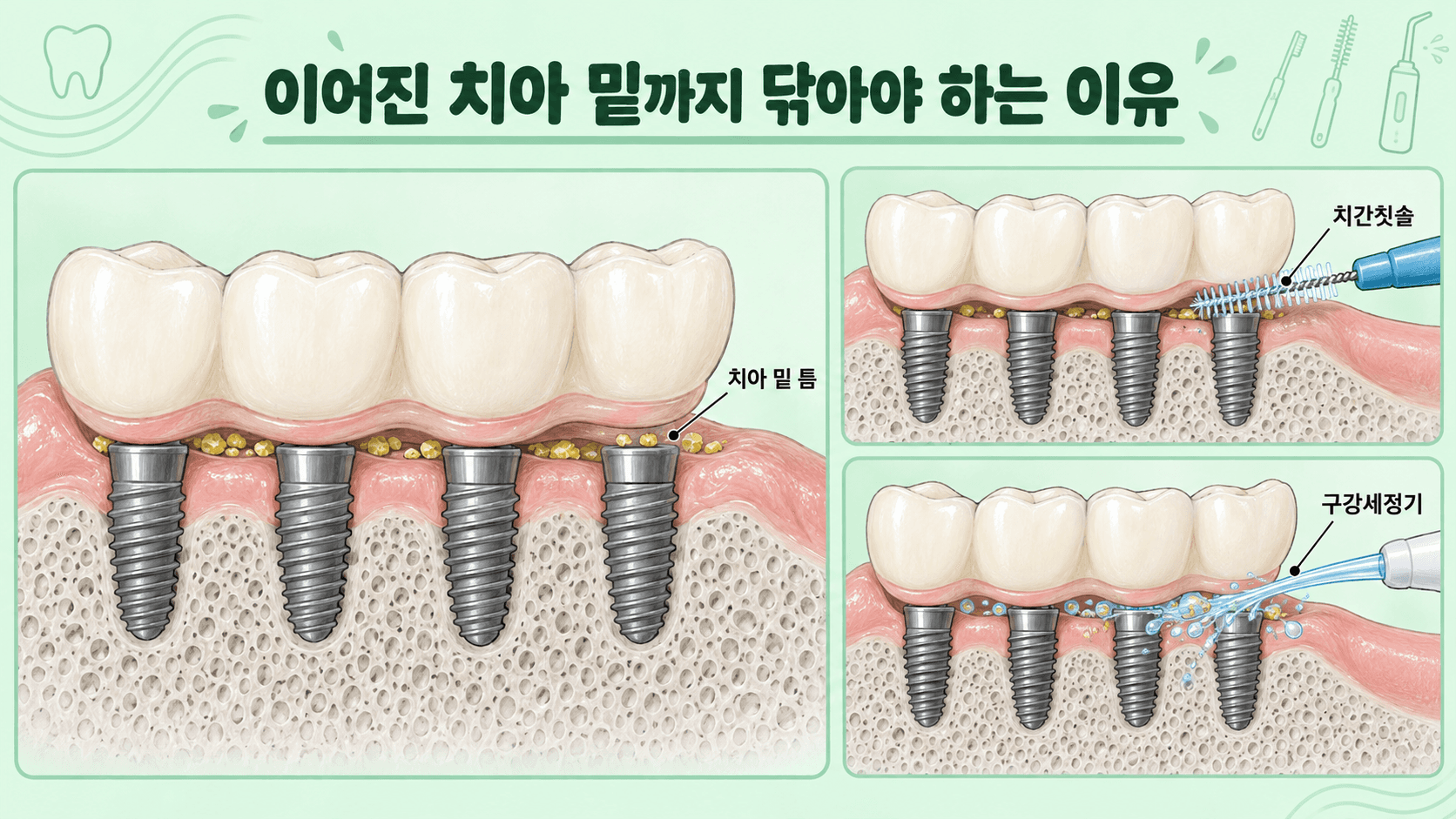 한 덩어리로 이어진 풀아치 임플란트 치아 밑 틈에 남는 음식물과 세균, 치간칫솔과 구강세정기로 닦는 방법을 보여 주는 일러스트