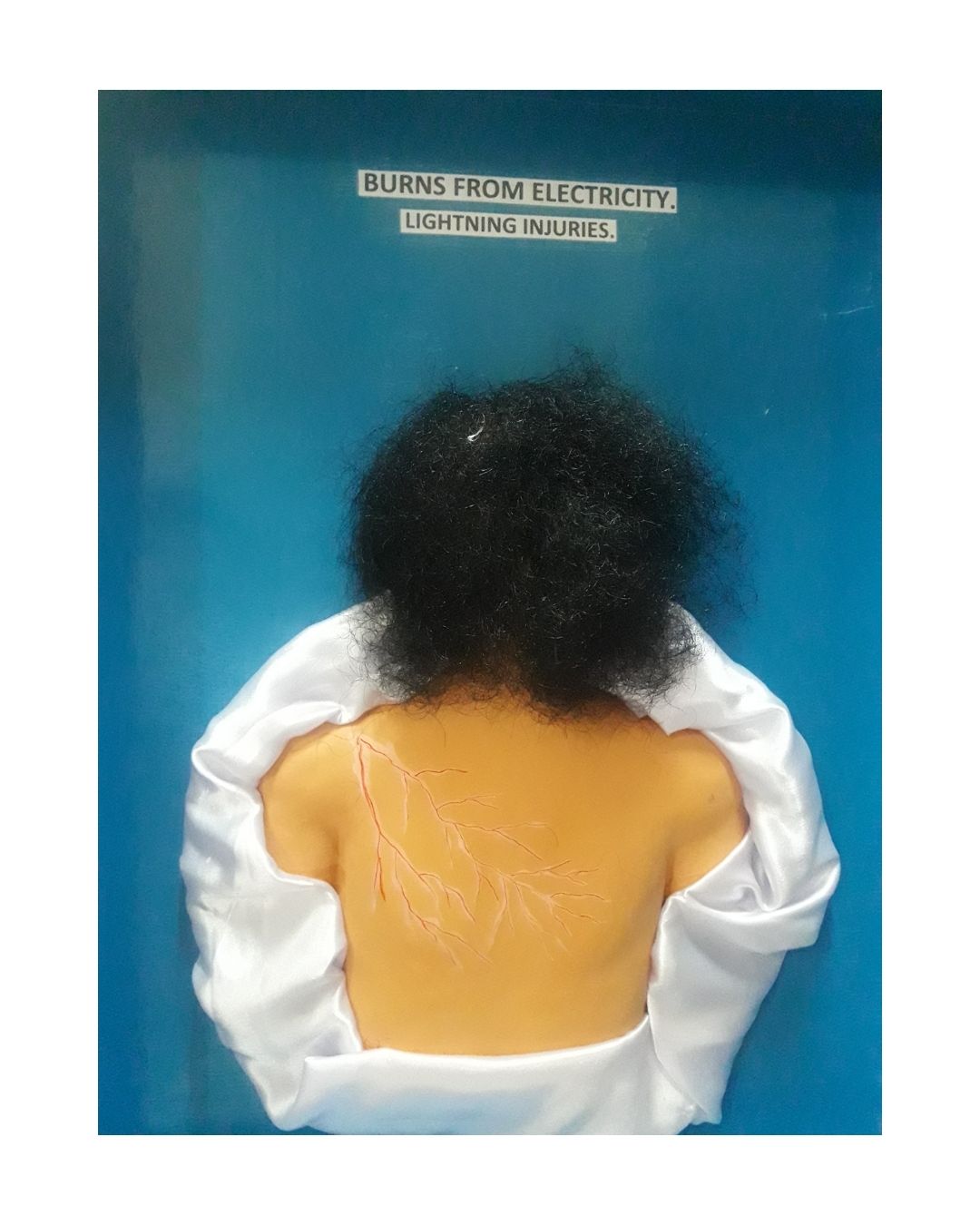 Burns From Electricity / Lightning Injuries