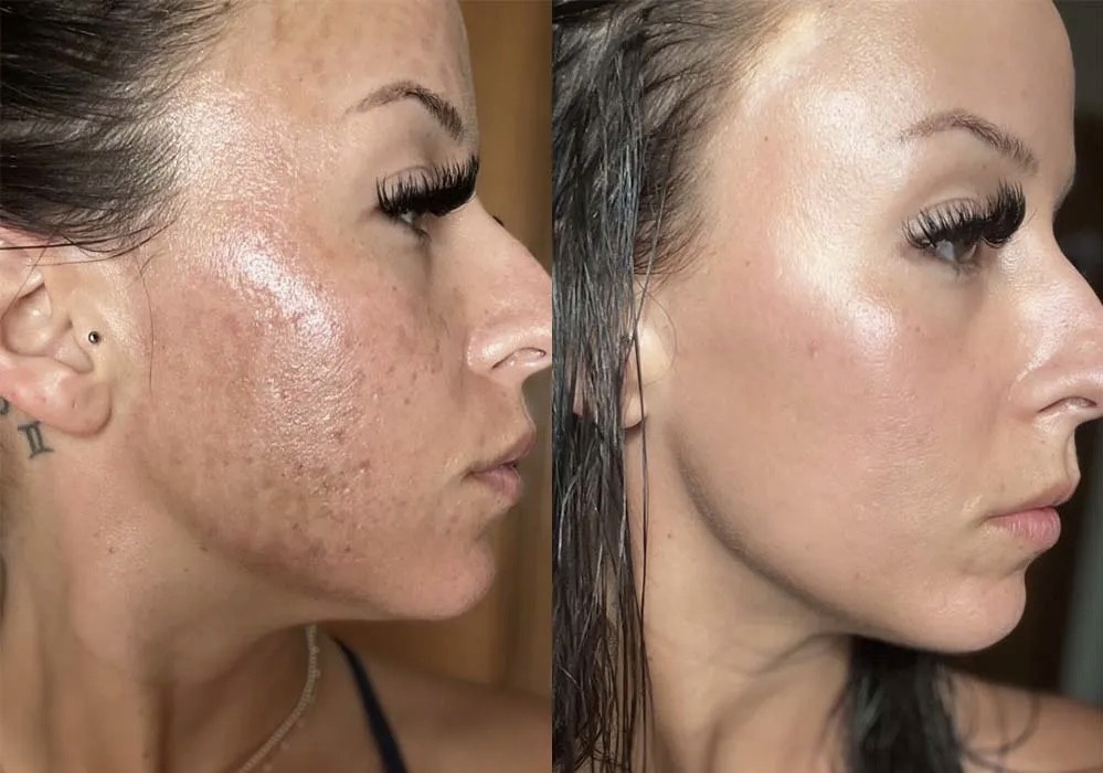 Laser treatment on woman's cheek with protective eye shield