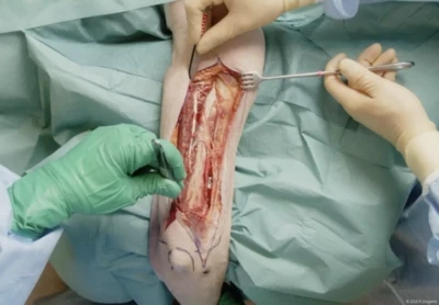 Posterior humerus approach