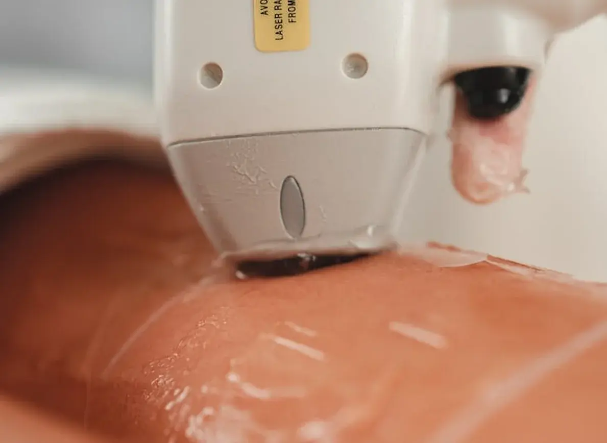 Laser facial skin rejuvenation treatment at aesthetic clinic.