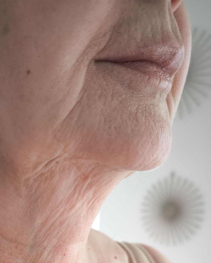 Ochabnutá pokožka krku a spodnej časti tváre pred liftingom stimulátorom Gouri