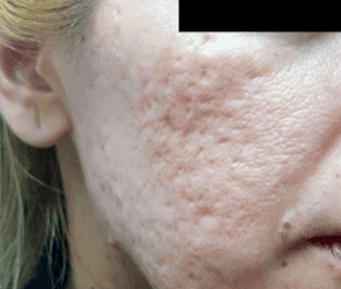 Before RF microneedling treatment